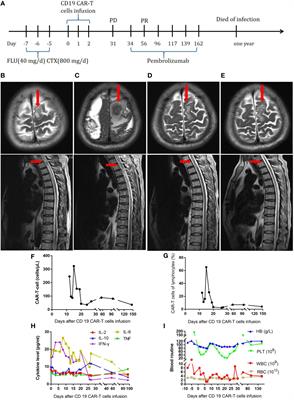 Strategies to overcome CAR-T cell resistance in clinical work: A single-institute experience
